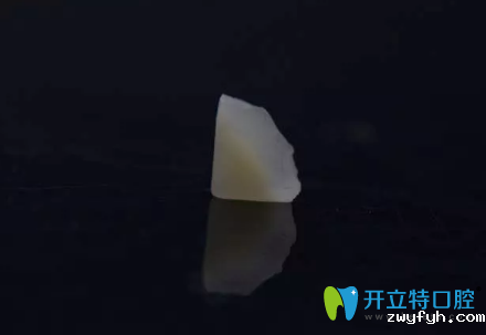 制作完成的嵌体修复