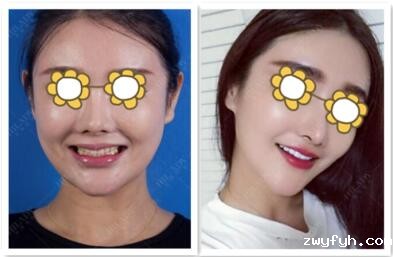 在郑州华领口腔做牙贴面美白7天让我成功逆袭成微笑少女