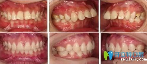 广州广大口腔广州广大口腔做牙齿正畸怎么样?龅牙/牙齿拥挤真人案例反馈