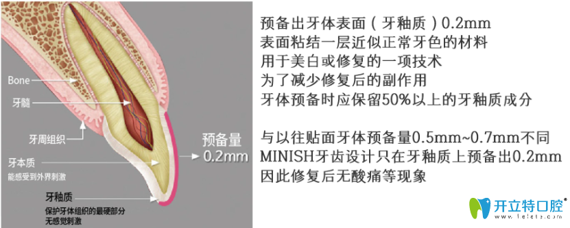 较少磨牙的minish牙齿贴面技术实现牙齿美白