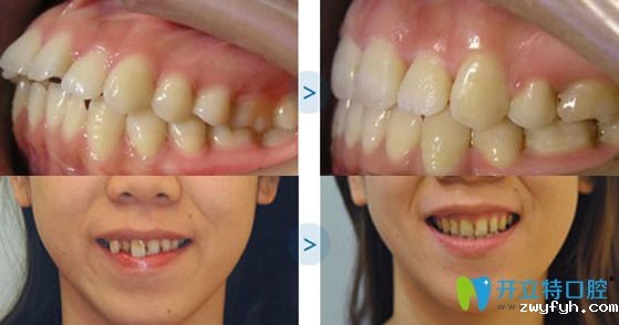 福州维乐口腔牙齿矫正术前术后对比案例