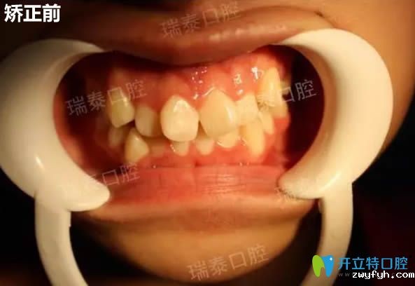 记录我去西安瑞泰口腔做时代天使隐形矫正14个月以来的感受