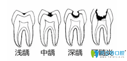 牙坏了一半烂掉了，这样的虫牙是补好还是拔好？