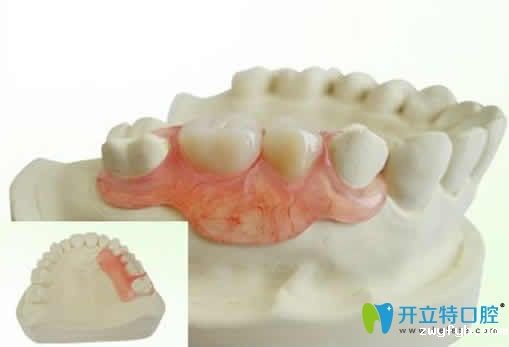 求问隐形义齿对邻牙有危害吗？揭秘隐形义齿的优缺点