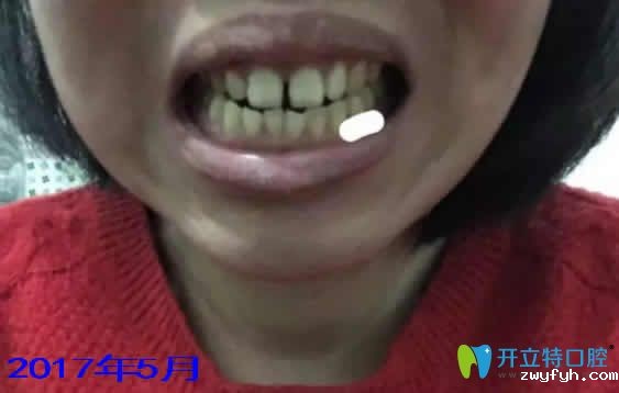 晒下牙齿稀疏的我在宁波协禾口腔做自锁托槽矫正前后效果