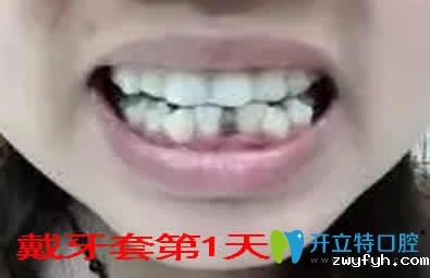 我在重庆嘉悦口腔做牙齿稀疏隐形矫正180天的效果分享