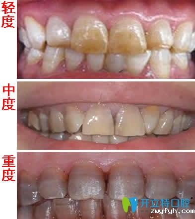 分享:四环素牙不同程度的图片及四环素牙是怎么形成的