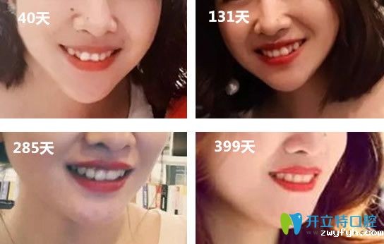 淄博可恩口腔隐适美矫正599天啦 上图并给大家说说我的感受