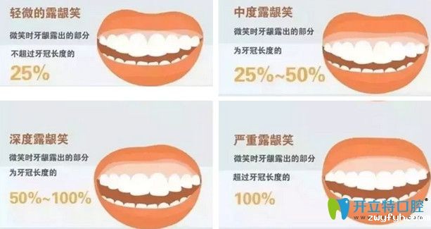 露龈笑可以矫正吗？公布露龈笑手术费用及矫正前后对比照