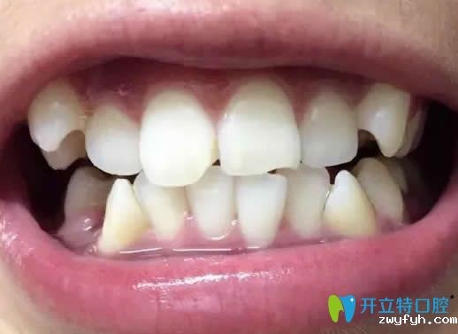 在昆明王巍口腔做金属牙齿矫正戴牙套16个月效果分享