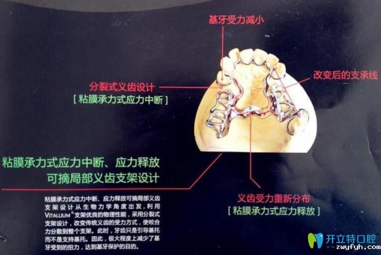 维他灵支架的优缺点公布，它和纯钛支架相比好的竟然是…