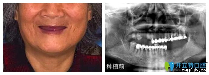林阿姨的穿颧骨全口种植牙是南京博韵口腔陈慧玲院长做的