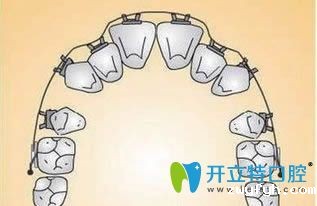 陶瓷牙套为什么容易掉?是因为陶瓷自锁托槽太厚了?不尽然吧