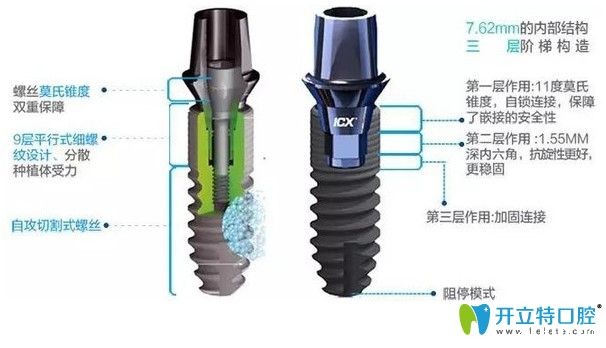 德国icx种植体优点