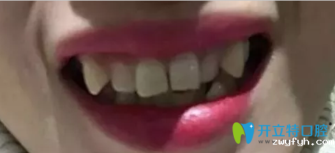 牙性龅牙突嘴的我,在珠海九龙口腔做牙齿矫正两年就整齐了!