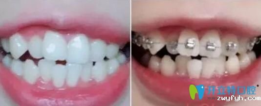 珠海牙齿矫正哪家好?我在仁爱口腔戴金属托槽1年半乱牙变齐