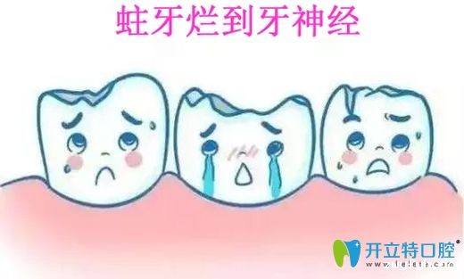 蛀牙怎么确定烂到神经简单,重点是牙齿烂神经该怎么办
