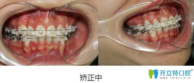 在深圳格伦菲尔口腔福田总店先后做了龅牙矫正和冷光美白