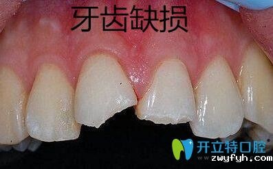 牙齿缺损修复选择金属牙冠、烤瓷牙冠和全瓷牙冠哪个好？