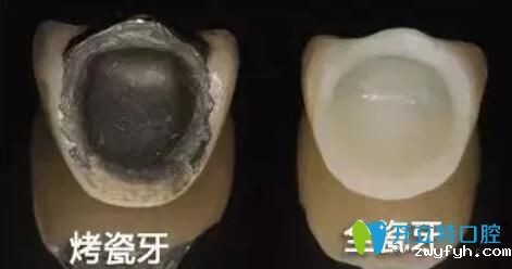 别只关心价格,德国西诺德全瓷牙好不好,看看内行人的分析