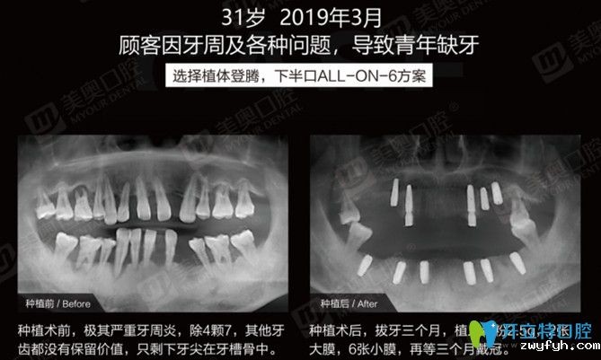 实锤！有案例证实患牙周炎照样可以做ALL-ON-6半口种植牙