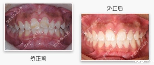 深覆盖矫正经历证实：隐适美在推磨牙后移方面的效果不错