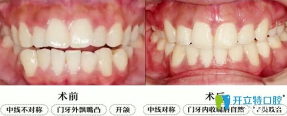 上排门牙外凸开颌隐适美牙套矫正2年毕业啦,大波对比图来袭