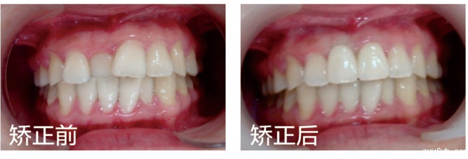 我做Ormco自锁托槽不拔牙矫正掏了2万多，这费用你觉得贵吗
