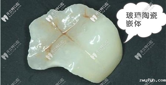 从玻璃陶瓷嵌体的优缺点和价格来分析这个牙嵌体怎么样?