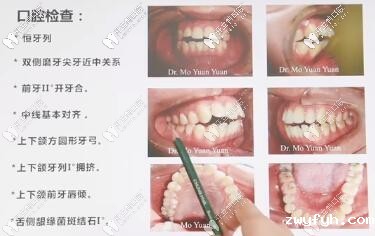 骨性前凸开颌,拔牙四颗,进口ormco自锁托槽矫正,历时22个月