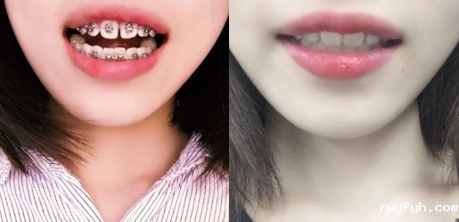 妹纸上牙前突想快速矫正,居然戴3M自锁托槽而不是隐形牙套