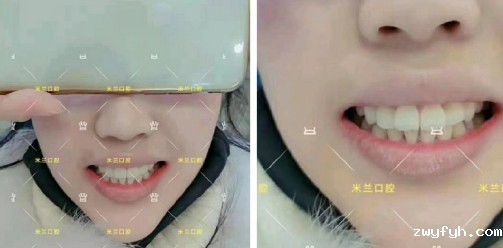 直到多生牙把门牙都挤变形了，才决定拔牙带3M自锁牙套矫正