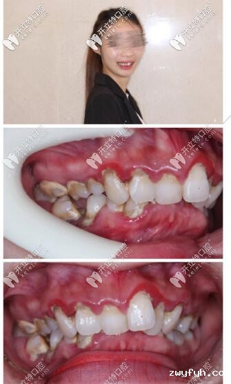 牙不齐深覆合3m自锁托槽矫正5个月,点赞海口这家高大上牙科