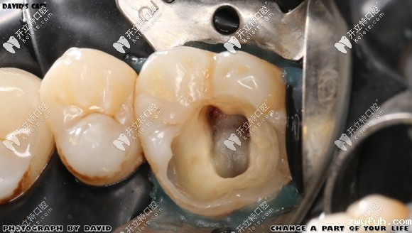 龋坏牙体去腐后的样子