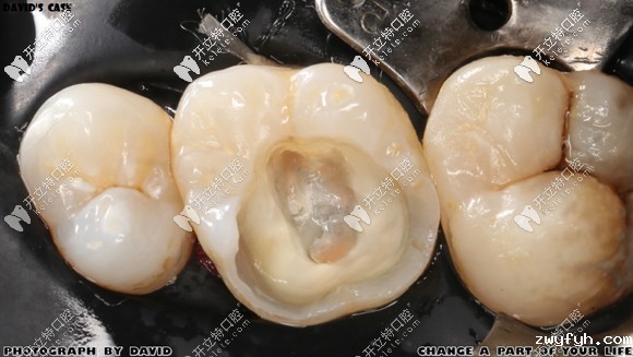 重度龋齿做根管治疗后的即刻照