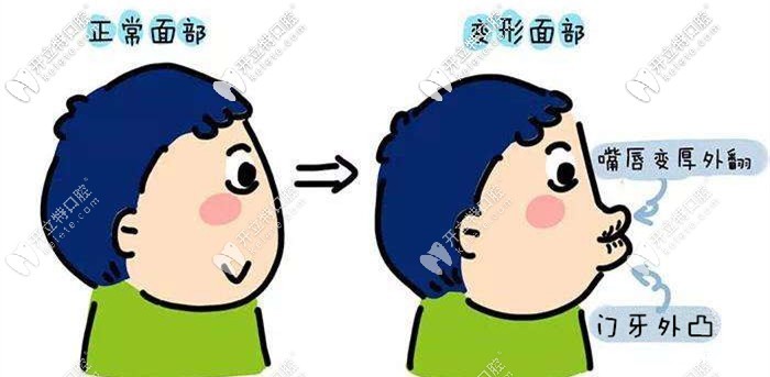 谁说门牙外凸不建议再矫正了,你以为每天按压就能改善嘴凸?