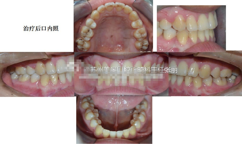 牙齿骨性反颌矫正变化也蛮大的,来猜猜我戴时代天使的费用
