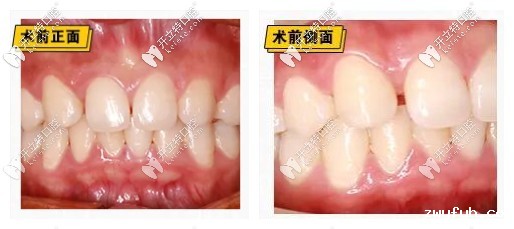 瓷贴面前的样子