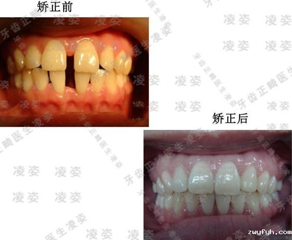 到上海圣贝口腔戴时代天使单膜,解决了4mm大的门牙牙缝问题