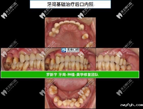 ​55岁重度牙周炎,成功在无锡美奥做了全口即刻负重种植牙