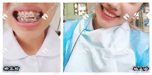 22岁嘴凸难看戴金属托槽牙套矫正牙齿的亲身经历