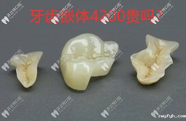 牙齿嵌体4200贵吗?只能说嵌体补牙材质不同价格也有差异哦