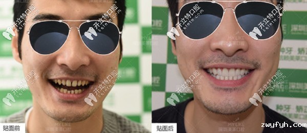 快速关闭牙缝,他选择在深圳美莱做了16颗Emax超薄全瓷贴面