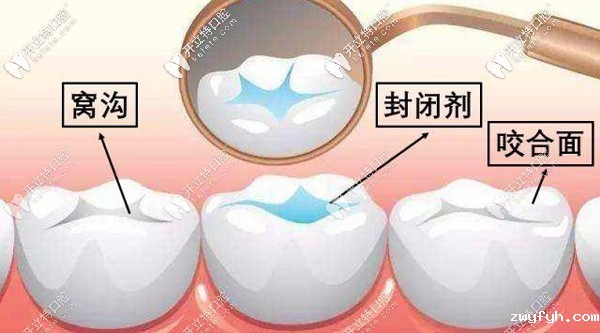 北京圣贝海淀牙科解锁儿童六龄齿窝沟封闭有必要做吗？