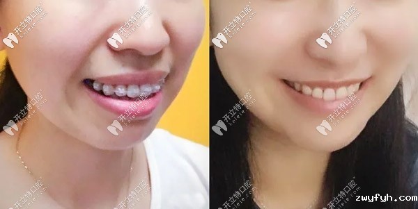 带了2年的陶瓷半隐形矫正终于把笑露牙龈的问题解决了