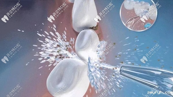 参照洗牙的分类等级表来自测你的牙齿需要做几级洗护