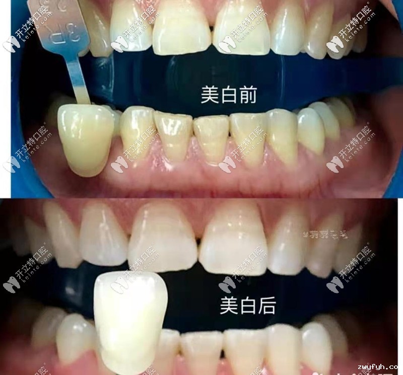 黄牙在西安曲江牙科做了冷光美白白了3个度,这价格值了
