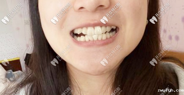 讲下牙齿拥挤的我戴上了金属自锁托槽矫正器的过程经历