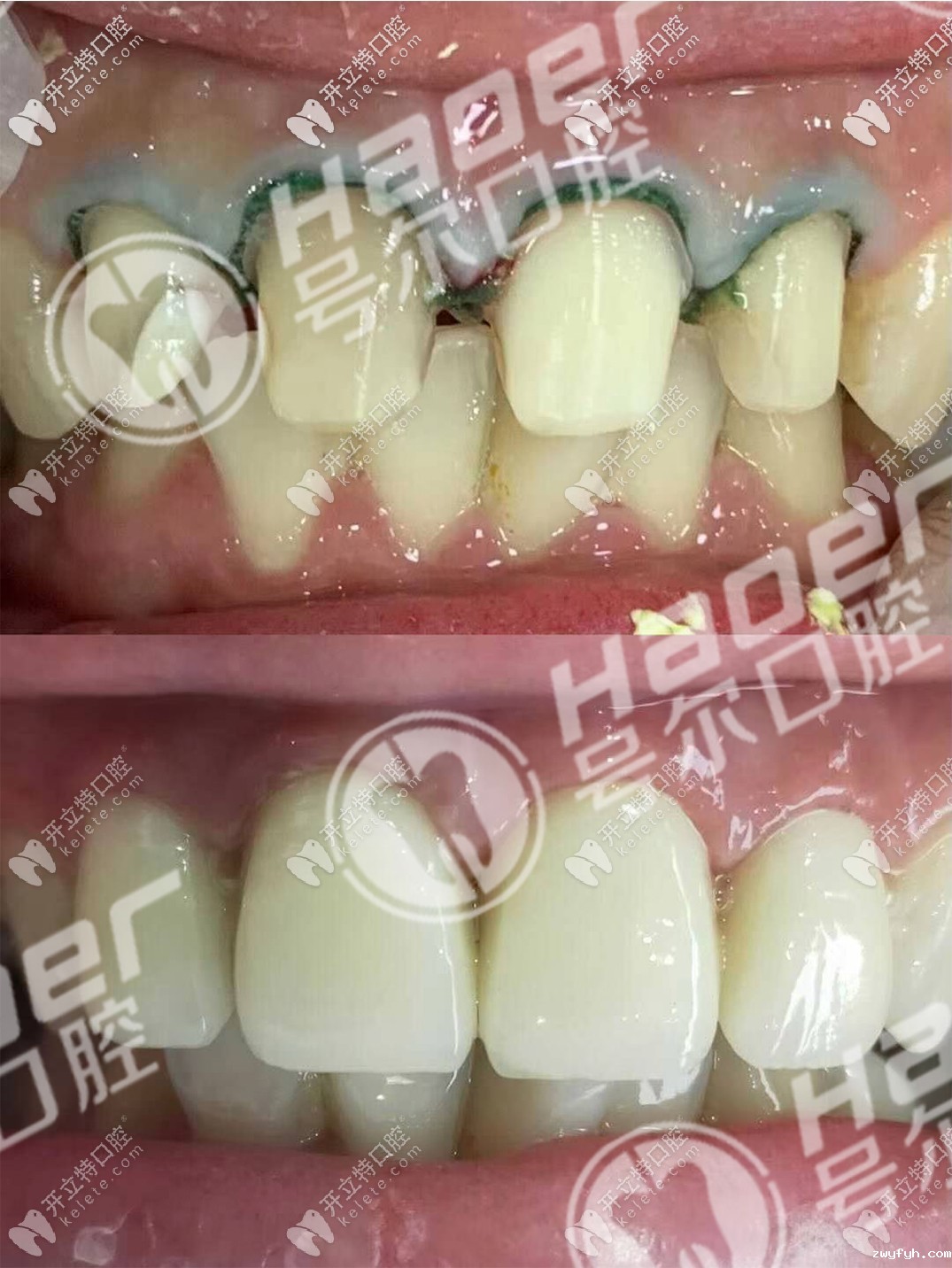 说不痛苦是假的,谈谈我烤瓷牙用5年后拆了换全瓷牙过程！