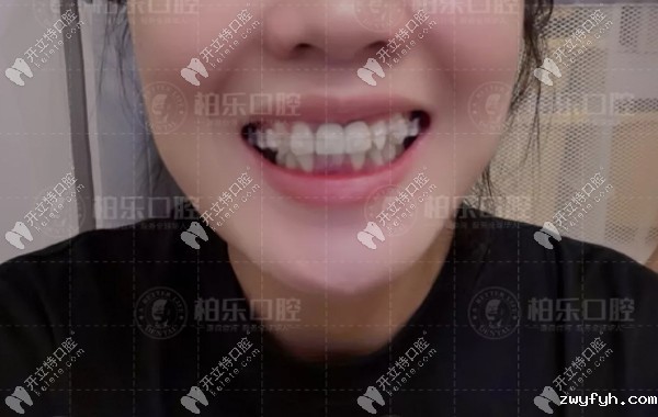 刚带上陶瓷隐形牙套